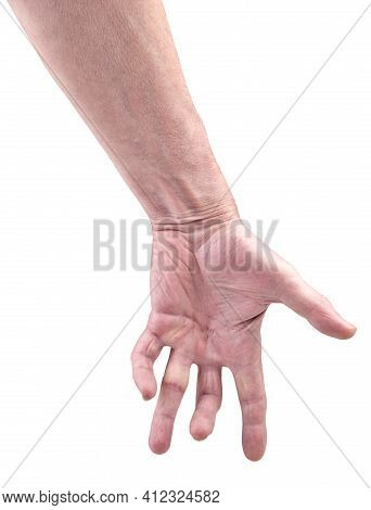 Hand Of An Man With Dupuytren Contracture Disease