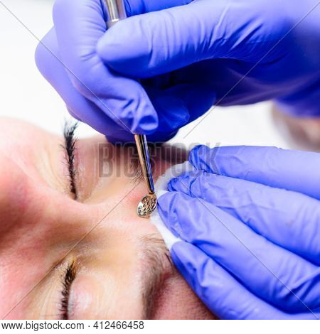 Mechanical Cleansing Of The Face With A Spoon Uno, Removing Grease And Blackheads.