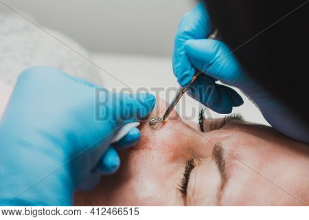 Mechanical Cleansing Of The Face With A Spoon Uno, Removing Grease And Blackheads.