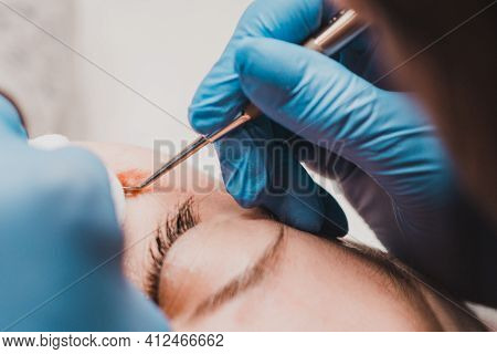 Milium On The Face, Removal Of Milia With A Syringe In Cosmetology.