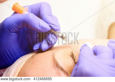 Miliums On The Face, Removal Of Hardened And Mature Milia By A Beautician.