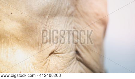 The Thin Old Man Skin With Close-up Old Skin With The Surgical Wound And The Wrinkle Old Skin .