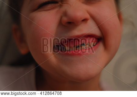 Little Boy Show Broken Teeth.boy With A Broken And Rotten Teeth. A Large Portrait. View From The Fro