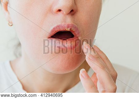 Close Up Of Girl Lips Affected By Herpes. Treatment Of Herpes Infection And Virus. Part Of Young Wom