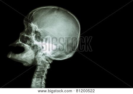 X-ray Skull Open Mouth ( Side View ) And Stroke ( Cerebrovascular Accident ( Cva ) )