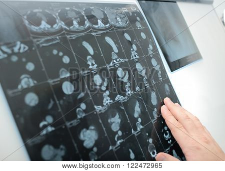 Doctor examines the CT picture on negatoscope.