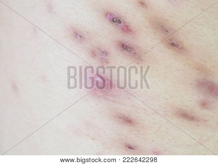 Closeup surface soft focus acne scars on back of body skin