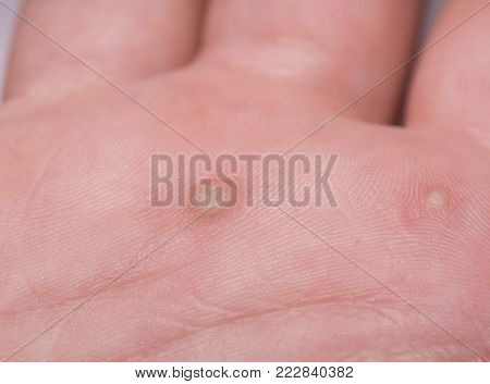 A flat wart commonly found on the hands and feet of children and young adults. They are caused by a type of human papillomavirus HPV