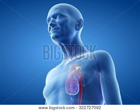 3d rendered illustration of an old man with a pace maker