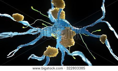3d rendered medical illustration of nerve cells suffering from alzheimer disease