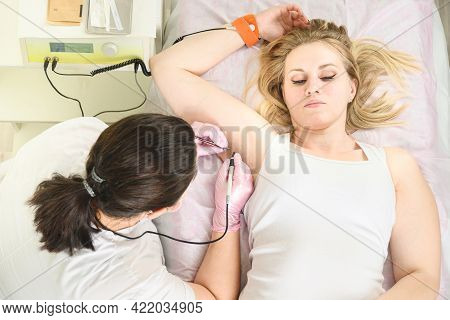 Removal Of Hair Permanently In A Womans Armpits Using Electrolysis.