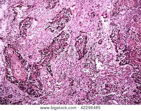 Central Lung Cancer Of A Human