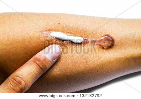 Treatment of scar on man arm on white background