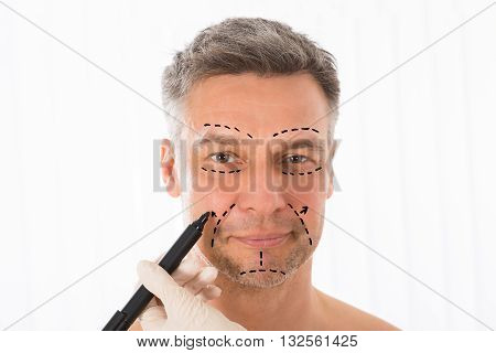 Close-up Of Surgeon Hands Drawing Correction Lines On Man Face With Marker