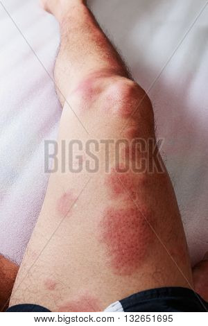 Around legs of man with dermatitis problem of rash allergy rash and Health problem.