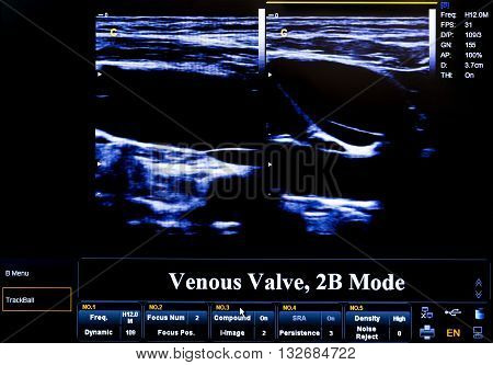 Colourful Ultrasound Monitor Image. Venous Valve