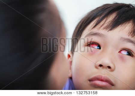 Closeup of chronic conjunctivitis with a red iris. Doctor medical check up eye patient. Mother take care her son