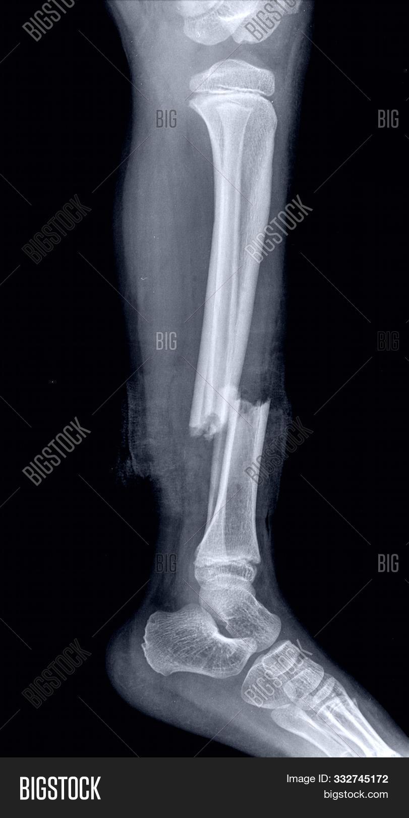 Radiografia Lateral De Image & Photo (Free Trial) | Bigstock