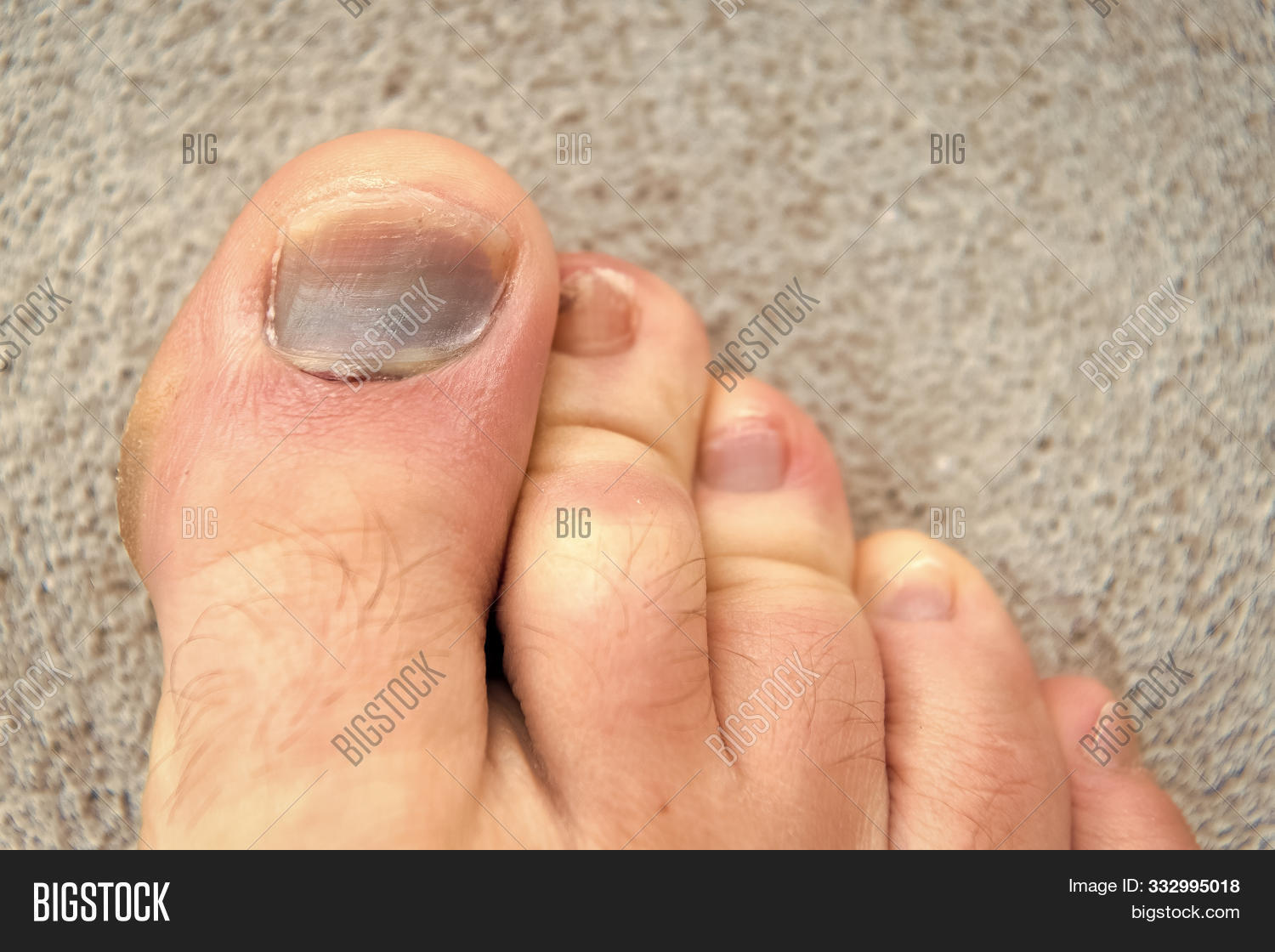 Toe Injury. Bruise Image & Photo (Free Trial) Bigstock