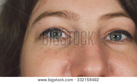 Woman With Under Eye Bag. Puffy Eye Of Girl Showing Eyes Bags. Womans Eye Close-up.