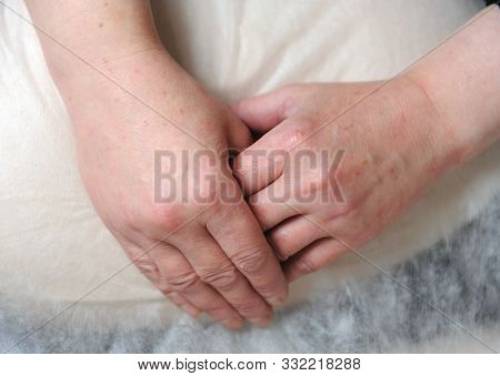 Reddened Skin On Hands After Carbon Dioxide Therapy (carboxytherapy)