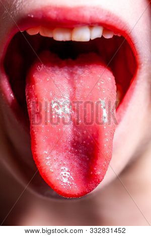 Tongue Of A Child With Scarlet Fever - Strawberry Tongue