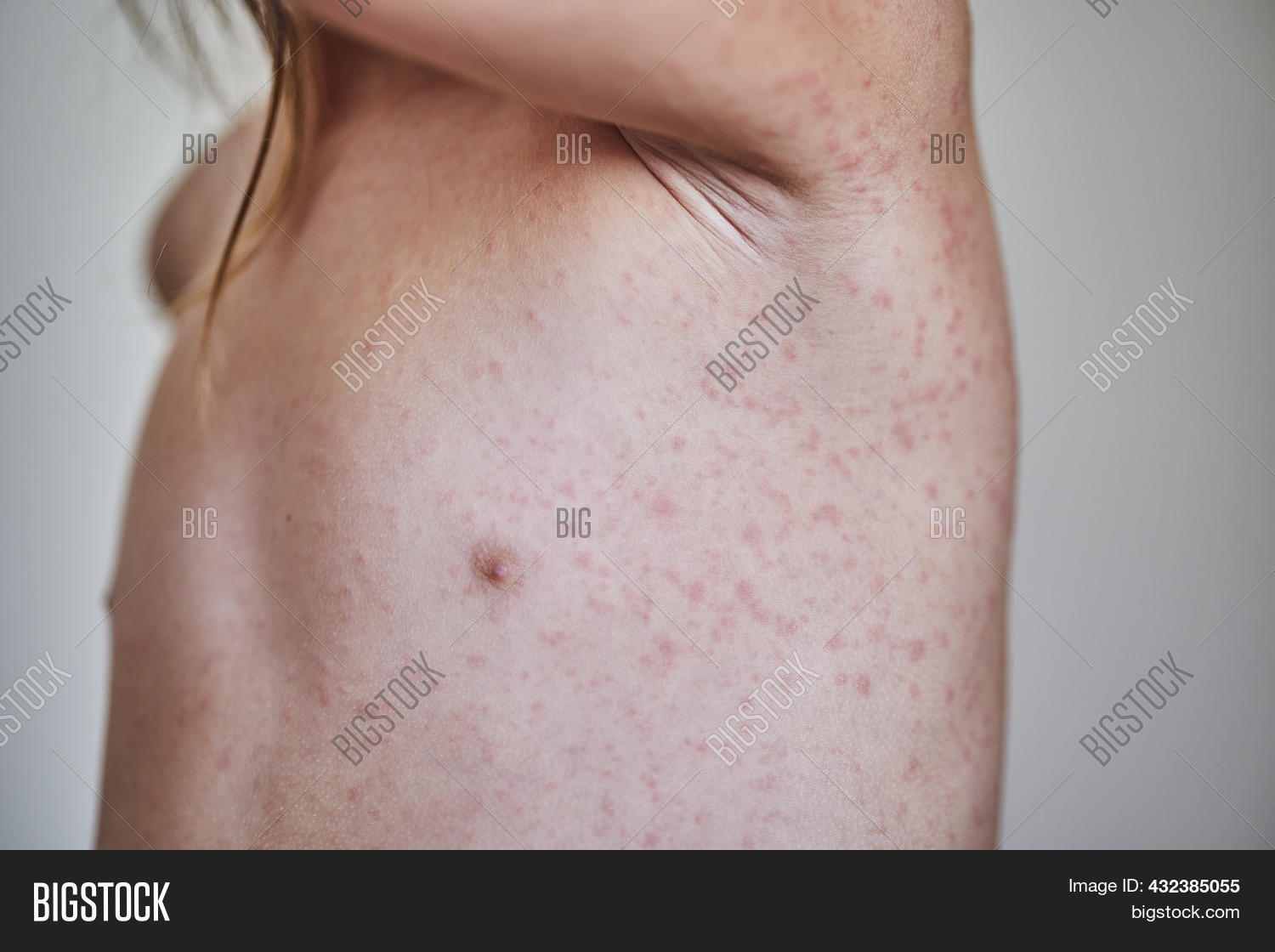 Allergic Rash On Body Image & Photo (Free Trial) | Bigstock