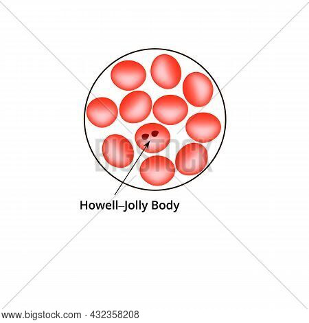 Howell Jolly Body. Anemia Of The Blood. Red Cells Are Erythrocytes In The Blood. Vector Illustration