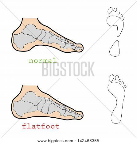 healthy legs and flat feet. track. vector illustration