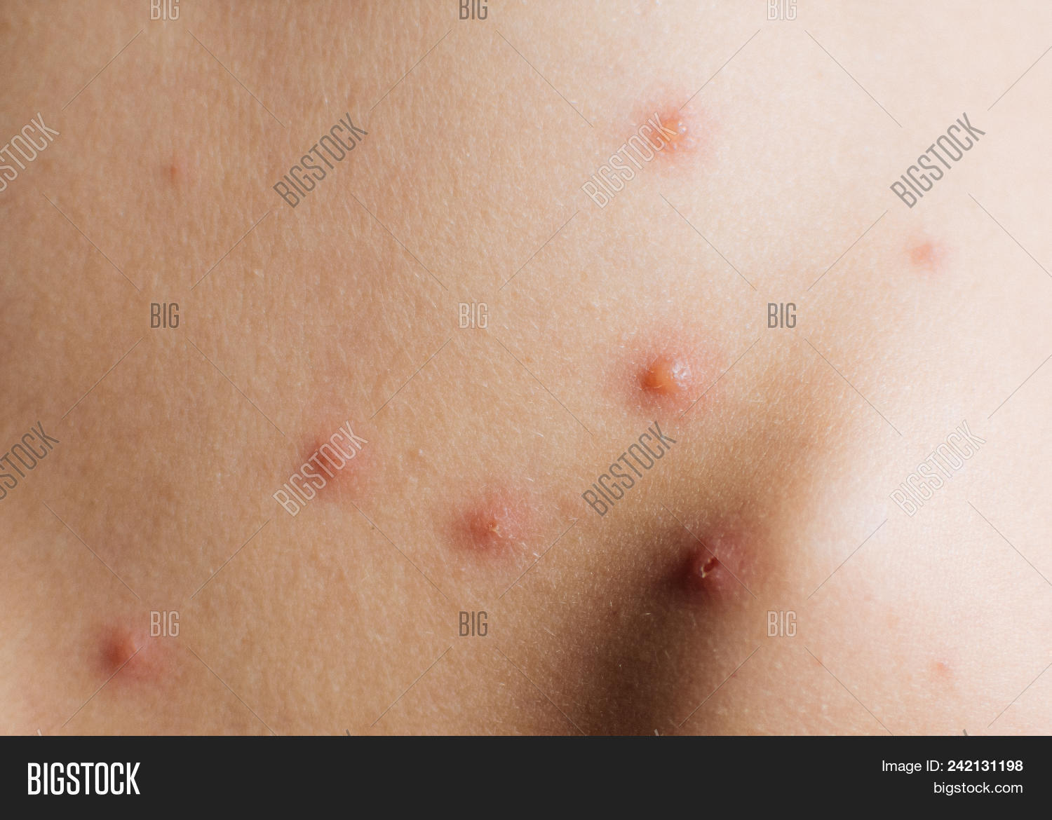 Chicken Poos Rash Detail Baby Chicken Image & Photo (Free Trial) | Bigstock