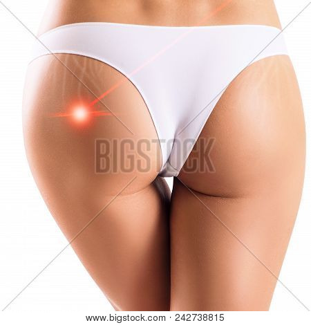 Female Buttocks With Laser Ray Removes Stretchmarks. Skin Treatment Concept.