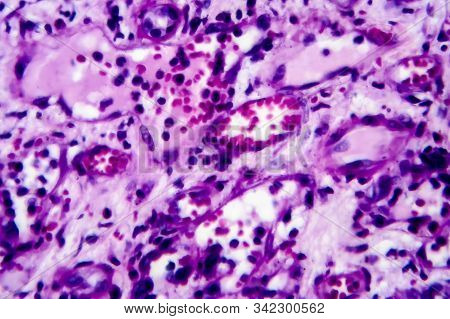 Histopathology Of Interstitial Nephritis, Light Micrograph, Photo Under Microscope. High Magnificati