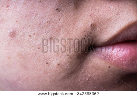 Ugly Pimples Blackheads On Cheek Face Of Teenager
