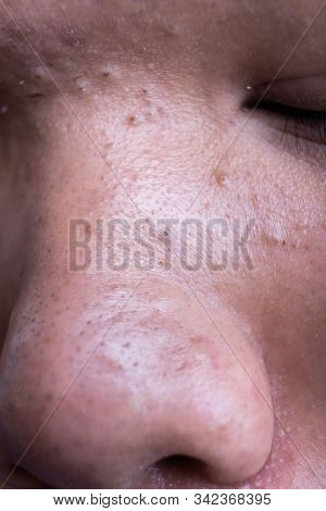 Ugly Pimples Blackheads On Nose Of Teenager Neglected Of Facecare