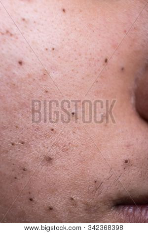 Ugly Pimples Blackheads On Cheek Face Of Teenager