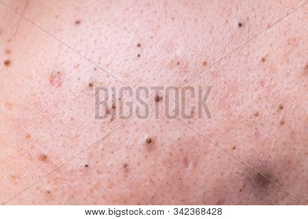 Ugly Pimples Blackheads On Face Of Teenager Neglected Of Facecare