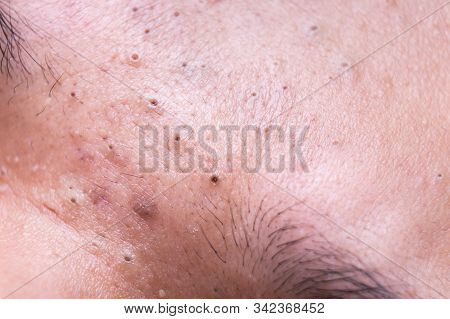 Ugly Pimples Blackheads On Nose Bridge Of Teenager