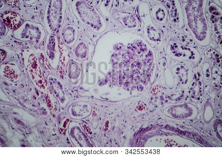 Acute Glomerulonephritis, Light Micrograph, Photo Under Microscope