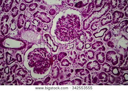 Histopathology Of Diffuse Sclerosing Glomerulonephritis, Light Micrograph, Photo Under Microscope