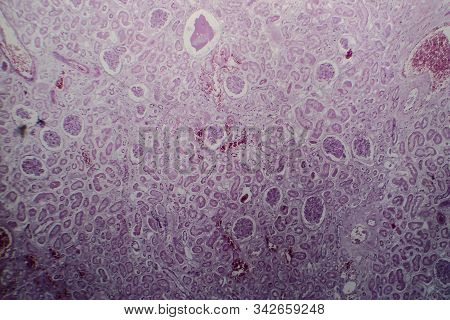 Acute Glomerulonephritis, Light Micrograph, Photo Under Microscope