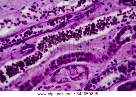 Diffuse Proliferative Glomerulonephritis, Dpgn, Light Micrograph, Photo Under Microscope. High Magni