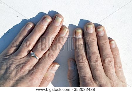 Fungal Nail Infection, Onycholysis After Shellac Or Gel-varnish. Isolated On White Background