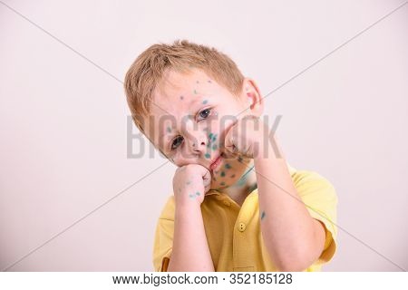 Young Toddler,boy With Chickenpox. Sick Child With Chickenpox. Varicella Virus Or Chickenpox Bubble
