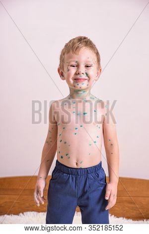 Young Toddler,boy With Chickenpox. Sick Child With Chickenpox. Varicella Virus Or Chickenpox Bubble