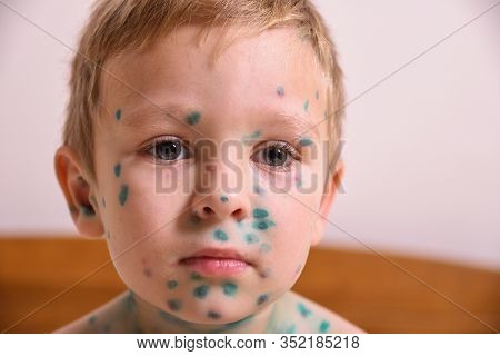 Young Toddler,boy With Chickenpox. Sick Child With Chickenpox. Varicella Virus Or Chickenpox Bubble
