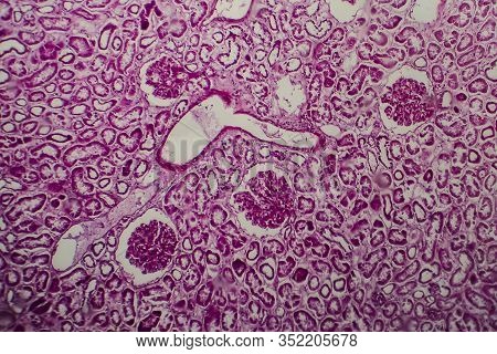 Histopathology Of Diffuse Sclerosing Glomerulonephritis, Light Micrograph, Photo Under Microscope