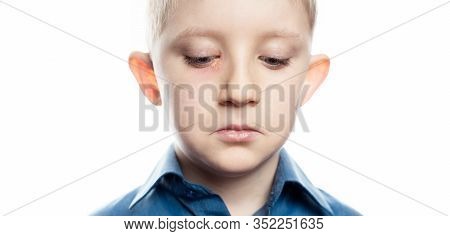 Herpes Is An Eye Disease On The Face Of A Child. Little Boy With Conjunctivitis. Rash Near The Eye. 