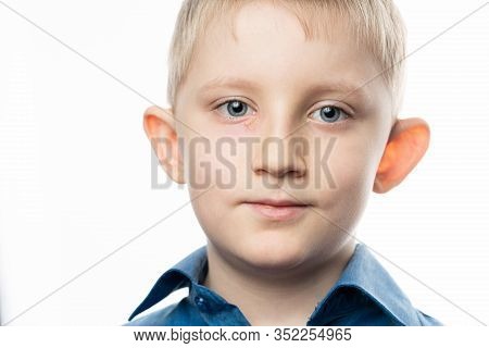 Herpes Is An Eye Disease On The Face Of A Child. Little Boy With Conjunctivitis. Rash Near The Eye. 
