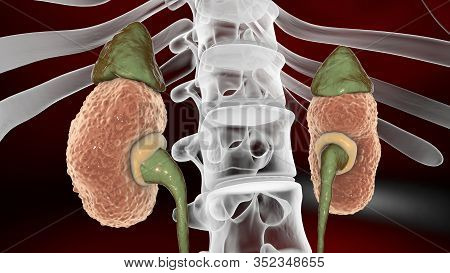 Gross Pathology Of Chronic Glomerulonephritis, 3d Illustration Showing Small Pale Contracted Kidneys