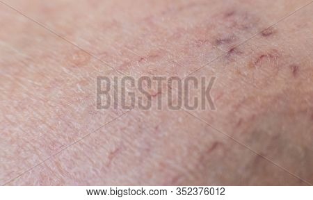 Vascular Asterisk On The Patient S Skin. The Concept Of Varicose Veins In Humans, Background, Macro,